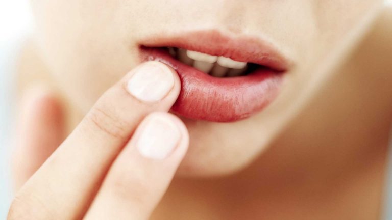 Aftas y su Tratamiento Homeopático