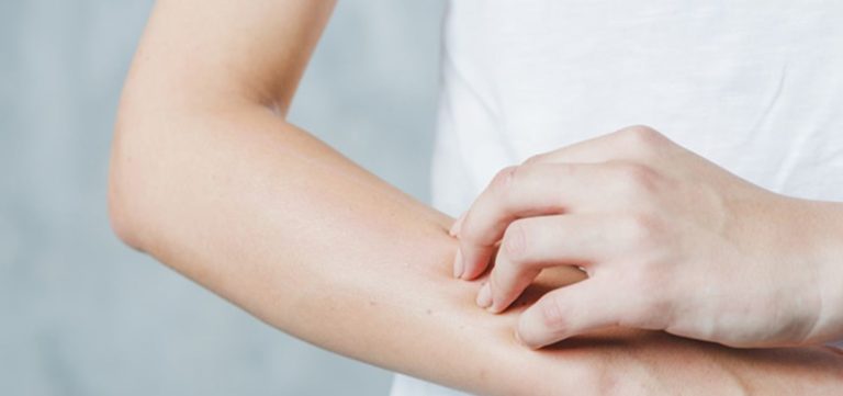 Dermatitis atópica