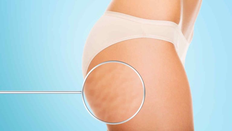 Cómo combatir ese enemigo que acecha: la Celulitis