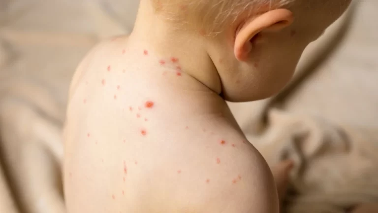 ¿La “culebrilla” es el virus de la varicela?