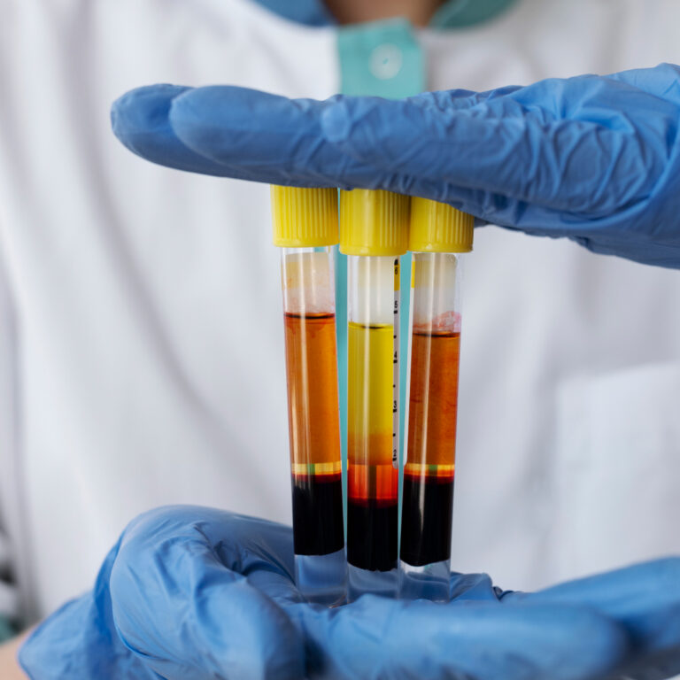 ¿Qué es el Plasma Rico en Plaquetas?