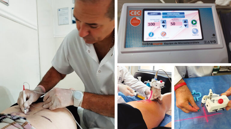 Micro electrólisis Percutánea: para alivio y recuperación de lesiones musculoesqueléticas