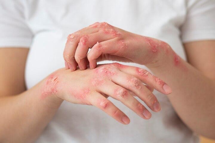 Lepra: una enfermedad curable, subdiagnosticada y estigmatizante