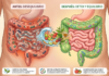 Détox o restauración del equilibrio intestinal