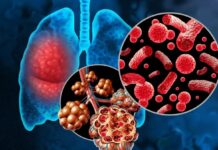 Neumonía, una enfermedad peligrosa